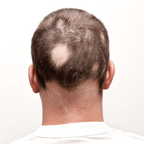 types of hair loss alopecia treatments