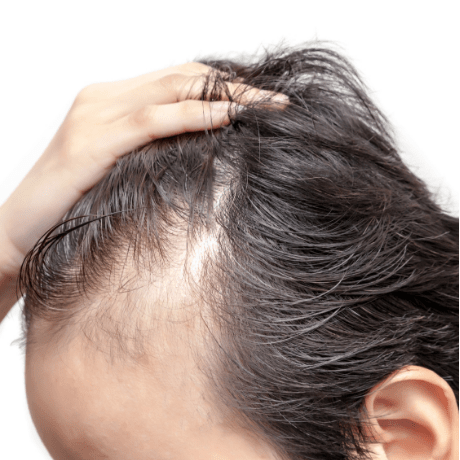 thinning hair hair loss scalp micropigmentation 