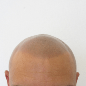 Scalp micropigmentation hair tattoo for hair loss