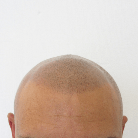 Scalp micropigmentation hair tattoo for hair loss