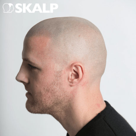 scalp micropigmentation on pale skin