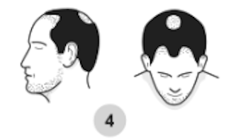 4th stage of male pattern baldness