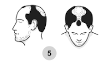 5th stage of male pattern baldness
