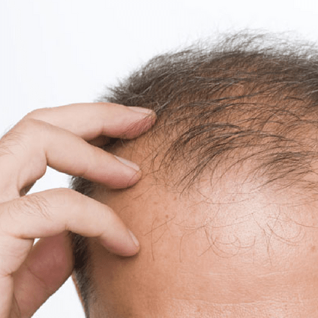 the problem with hair transplants blog post