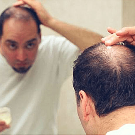 preventing baldness