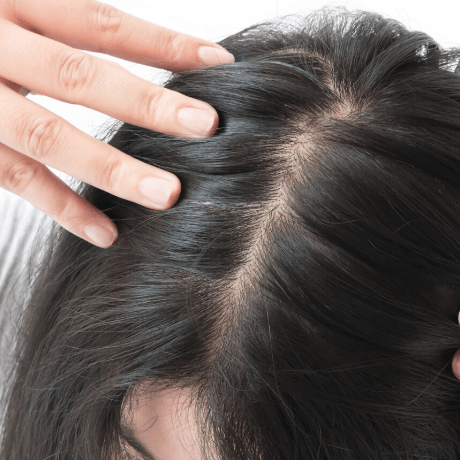 womens hair loss at parting