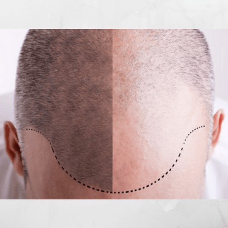 what is male pattern baldness