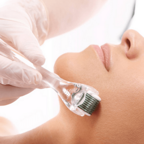 what is micro needling for hairloss?