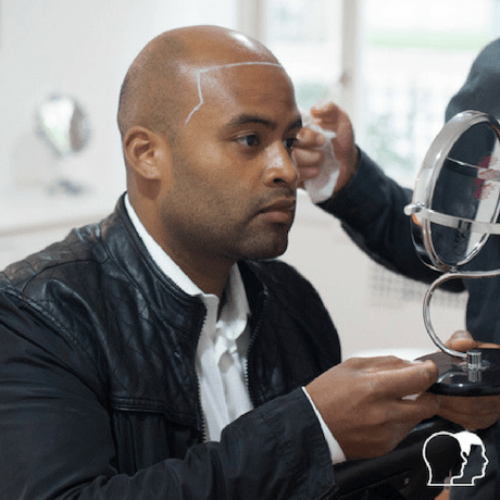 drawing hairline at first scalp micropigmentation session skalp clinic