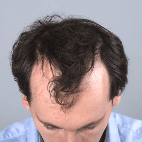 Can hairline be re-grown through hair transplantation? | Hair Sure