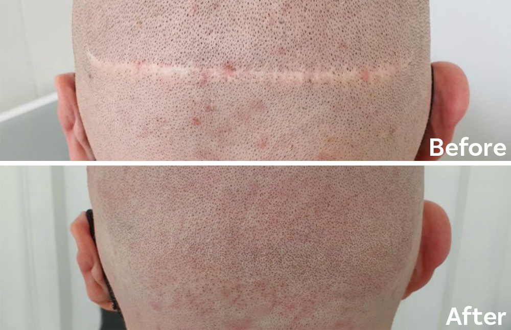 Hair transplant scar camouflage with Scalp Micropigmentation