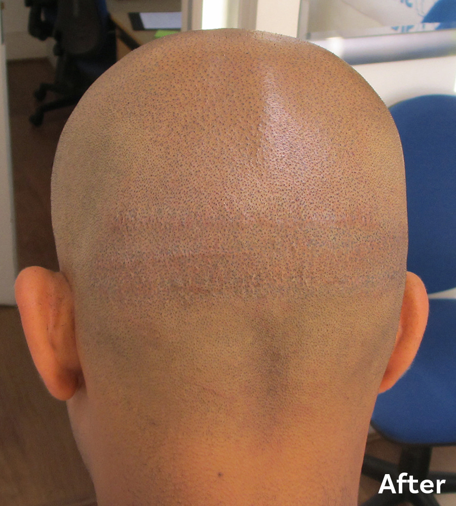 Hair Transplant Scars After