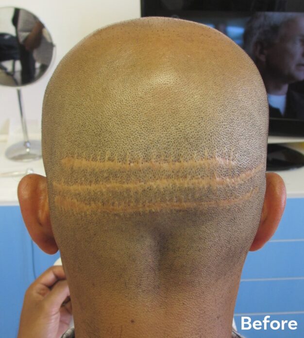 Hair Transplant Scars before