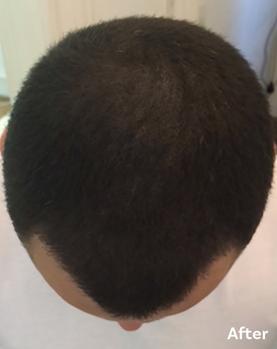 SMP after Hair Transplant