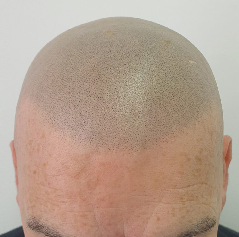Scalp Micropigmentation Gone Wrong Skalp