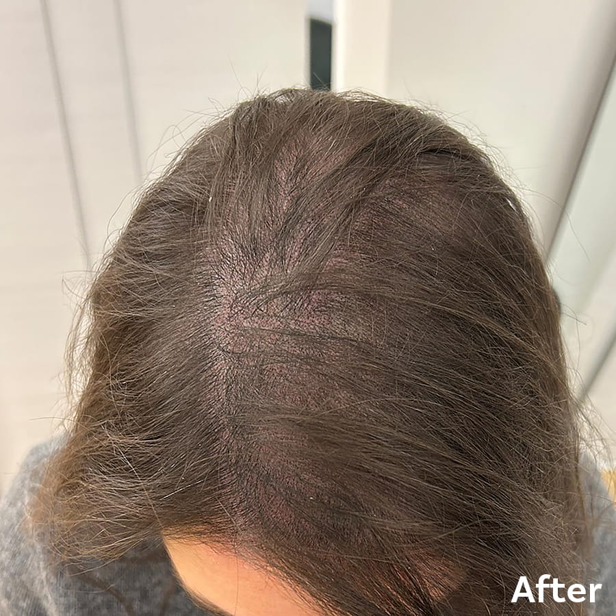 Female Scalp Micropigmentation after