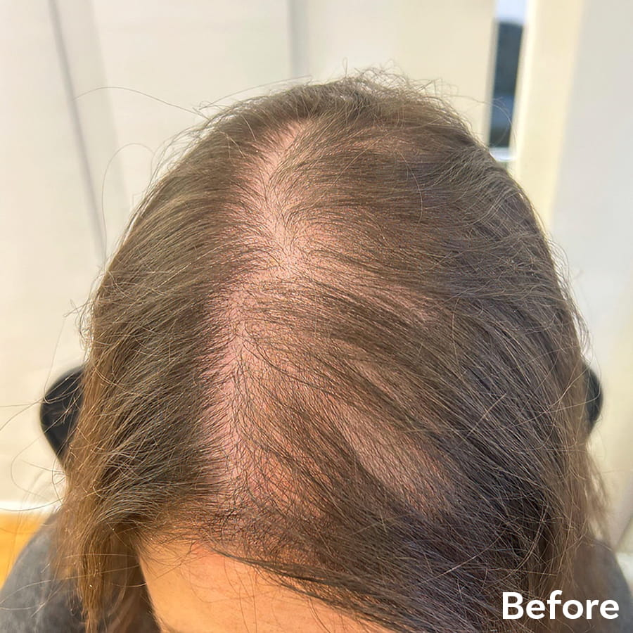 Female Scalp Micropigmentation before