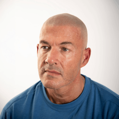 Man in their 40's with scalp micropigmentation