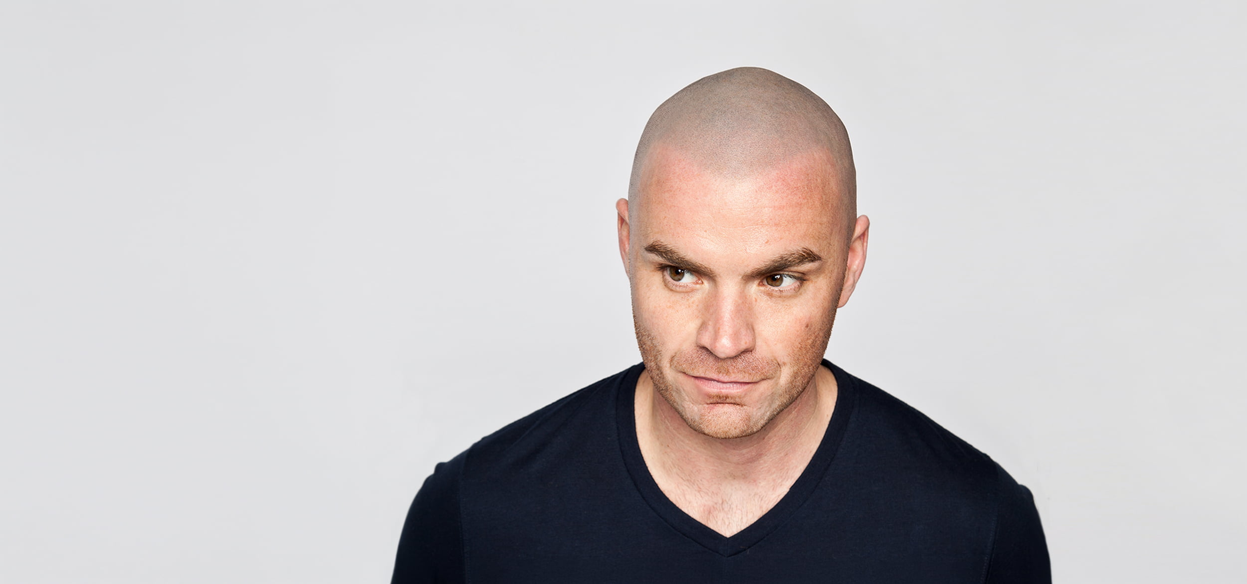 Scalp Micropigmentation Dublin